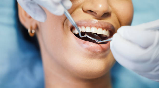 Best Knocked-Out Tooth (Avulsed Tooth) Treatment in University City, MO